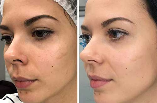 Hydro Facial in Norwich Before and After Impact 2