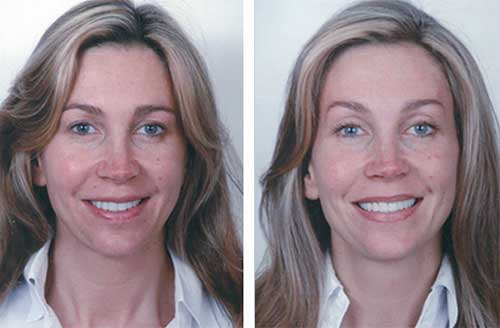 Hydro Facial in Norwich Before and After Impact 3