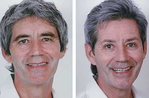 Hydro Facial in Norwich Before and After Impact 1
