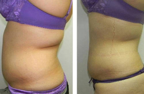 Inch Loss Body Contouring 3
