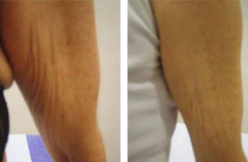 Inch Loss Body Contouring 5