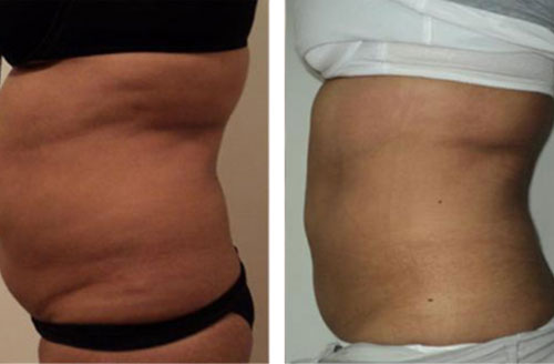 Inch Loss Body Contouring 5