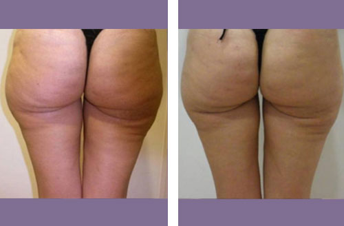Inch Loss Body Contouring 4