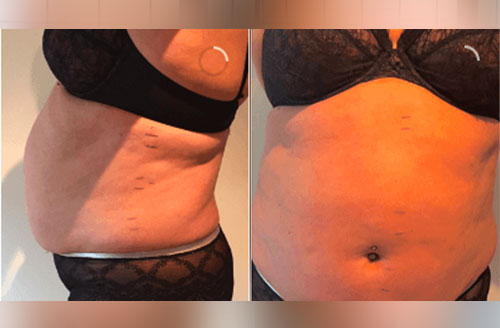 Inch Loss Body Contouring 1