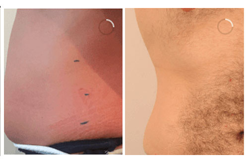 Inch Loss Body Contouring 2