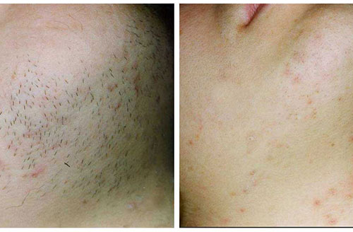 Ipl Hair Before & After
