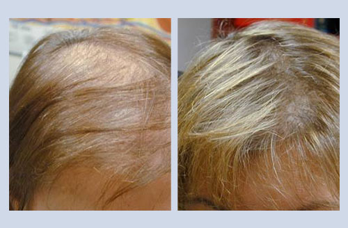 laser Hair After