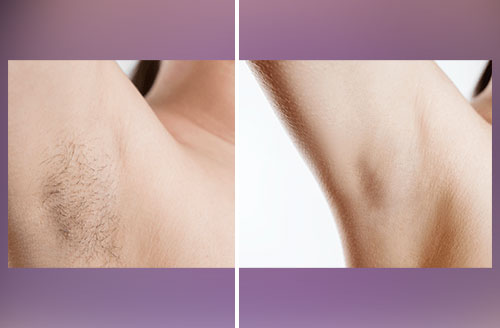 Laser Hair Removal 1