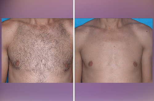 Laser Hair Removal 2