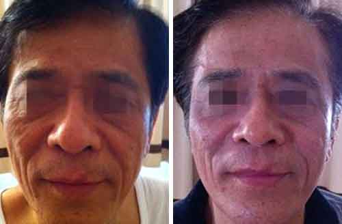 Lipofirm Before