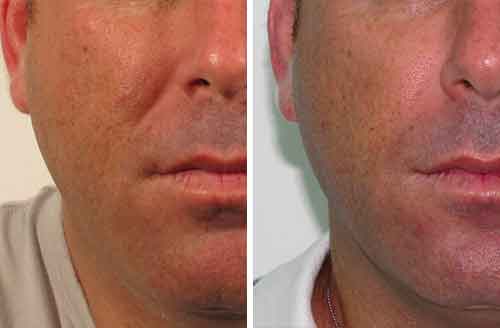 Lipofirm Before2