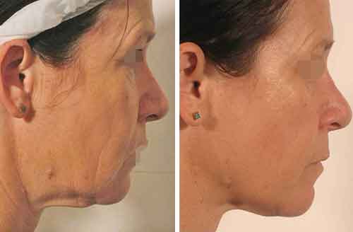 Lipofirm Before3