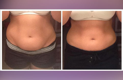 Lipolift Pro Body Contouring Wrap 1