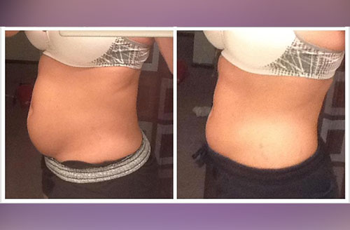 Lipolift Pro Body Contouring Wrap 2