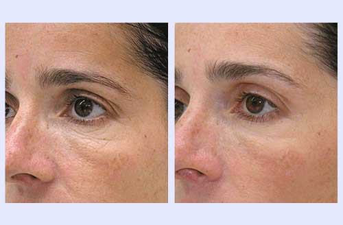 Mesotherapy Before and After 2