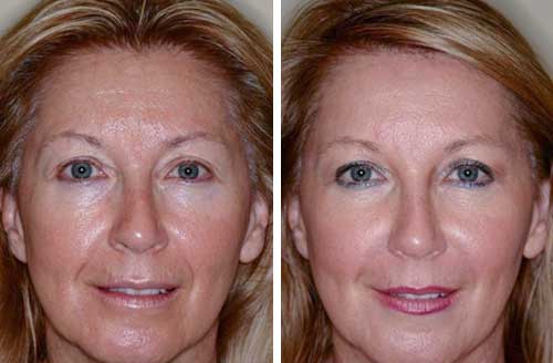 Mesotherapy Before and After 3