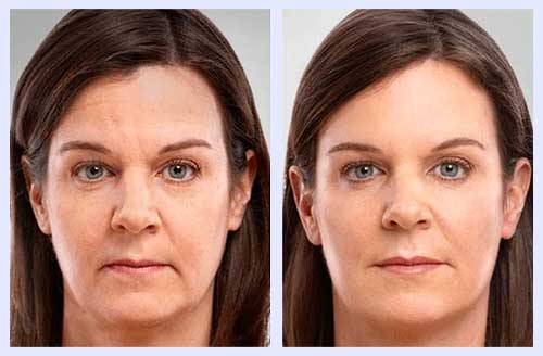 Mesotherapy Before and After 1