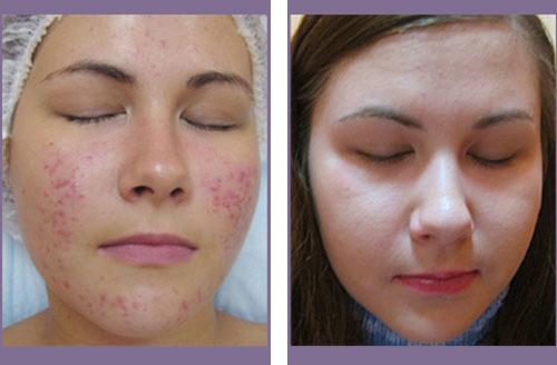 Non Ablative Before And After 1
