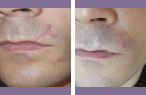 Non Ablative Before And After 3