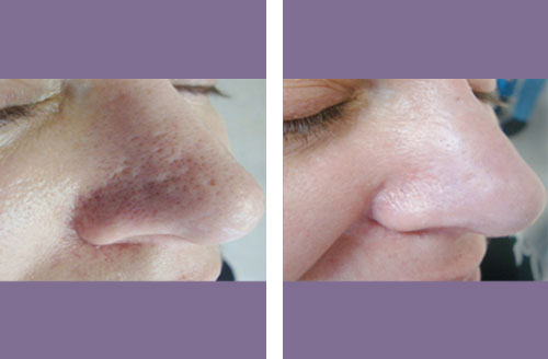 Non Ablative Before And After 2
