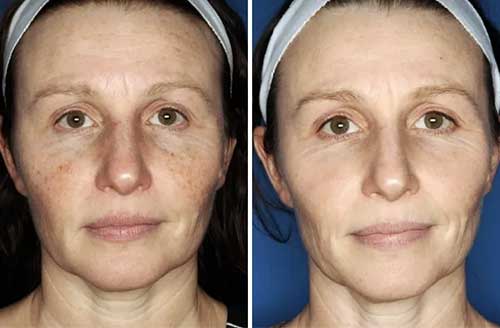 Photo Rej Before & After 1