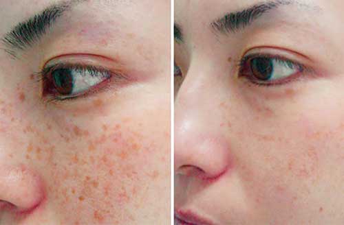Photo Rejuvenation Before & After 2