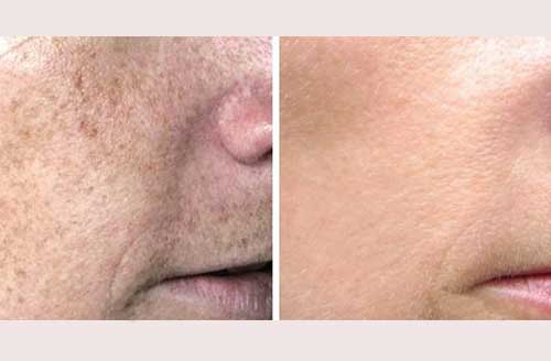 Photo Rejuvenation Before and After 3
