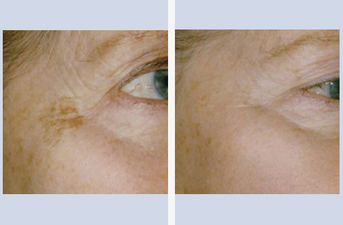 Pigment After