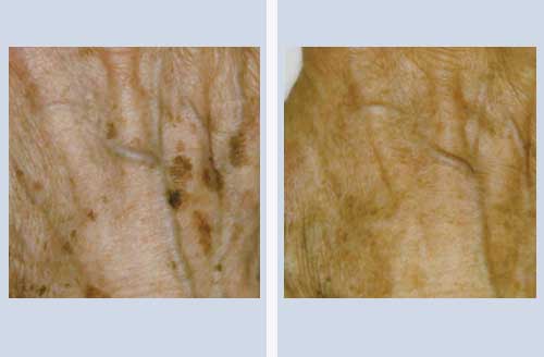 Pigment Before & After