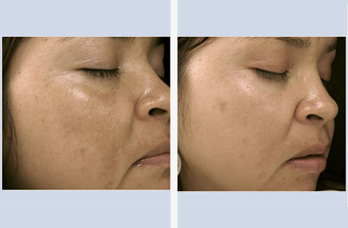 Pigment After
