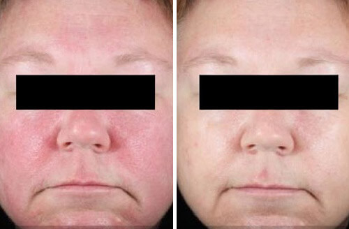 Rosacea After 1