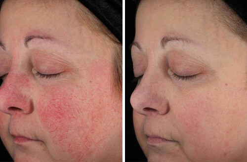 Rosacea After