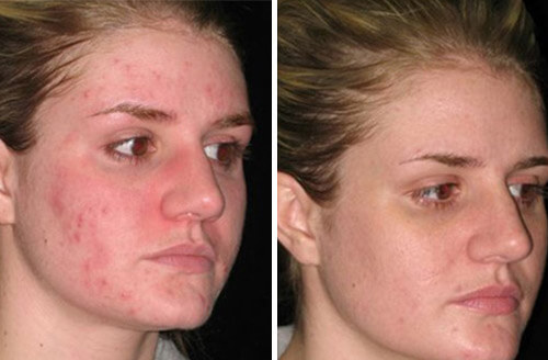 Rosacea After 2