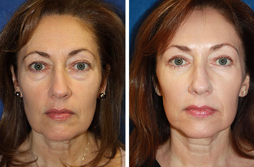 Skin Rejuv Before & After