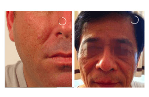 Skin Tightening Treatment Before and After Treatment