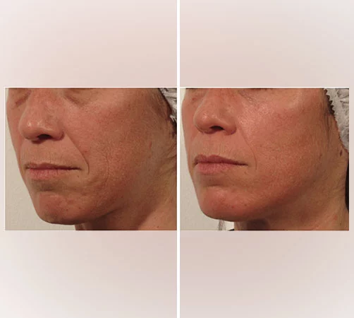 the pyramid facelift before and after
