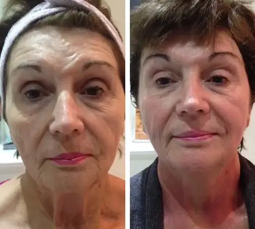 Touch Skin Plasma Therapy Estetika Clinic 1