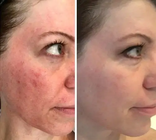 Touch Skin Plasma Therapy Estetika Clinic 2