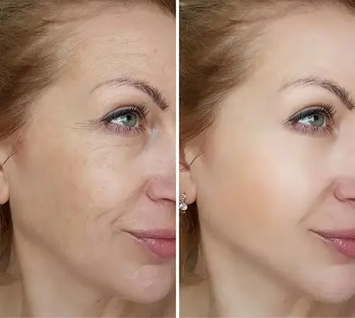 Touch Skin Plasma Therapy Estetika Clinic 3
