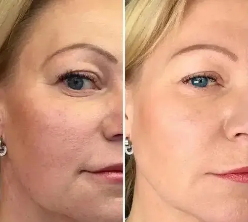 Touch Skin Plasma Therapy Estetika Clinic 4