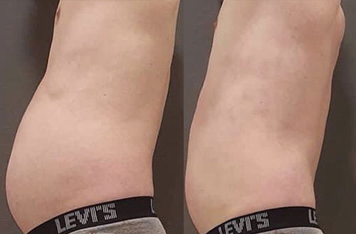 Waves 21 treatment before and after 5